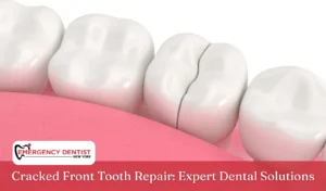 Cracked Front Tooth Repair Expert Dental Solutions