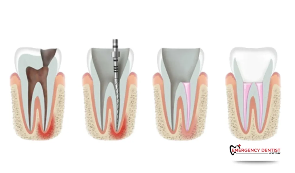 Different Types of Tooth Cracks