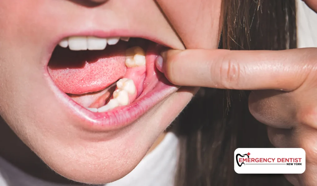 Tooth Pain After Tooth Pulled Healing or Dry Socket