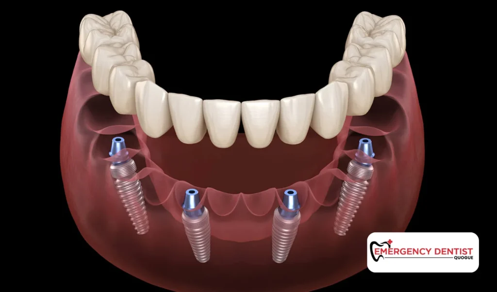 Considering Dental Implants After Extraction