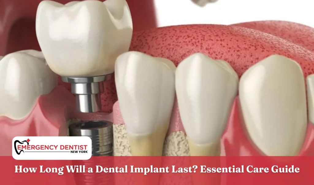 How Long Will a Dental Implant Last Essential Care Guide