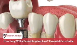 How Long Will a Dental Implant Last Essential Care Guide