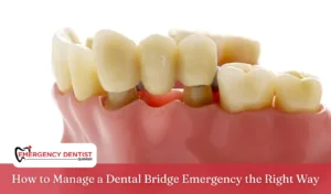 How to Manage a Dental Bridge Emergency the Right Way