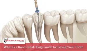 What Is a Root Canal Easy Guide to Saving Your Tooth
