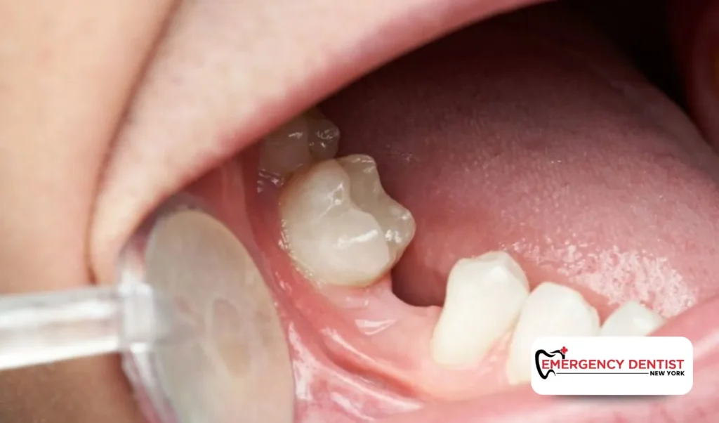 How Dry Socket Develops