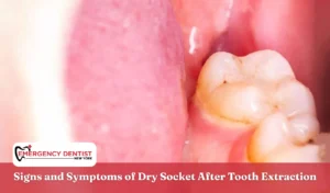 Signs and Symptoms of Dry Socket After Tooth Extraction
