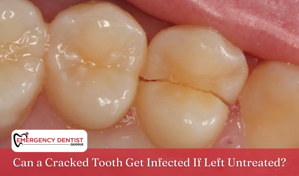 Can a Cracked Tooth Get Infected If Left Untreated