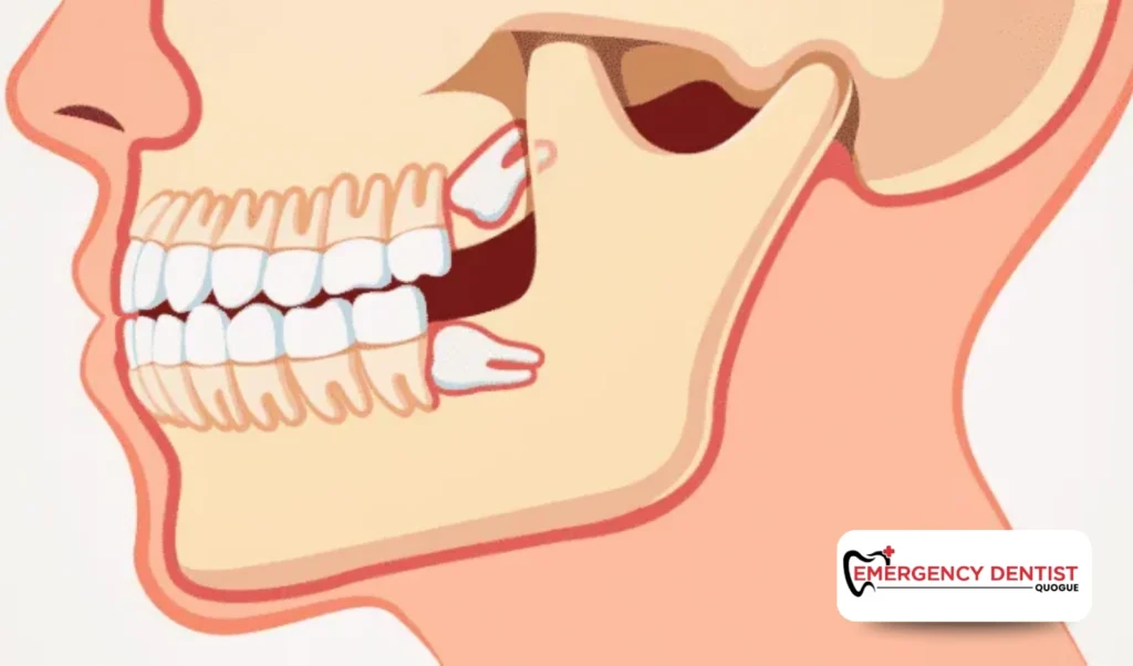 How an Impacted Wisdom Tooth Affects Cost
