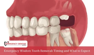 Emergency Wisdom Tooth Removal Timing and What to Expect