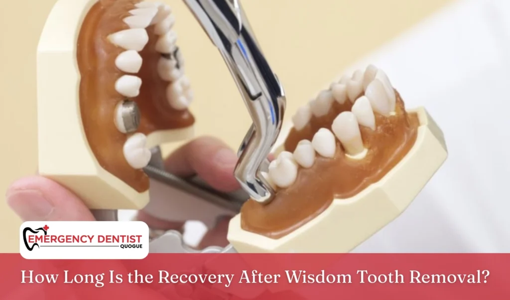 How Long Is the Recovery After Wisdom Tooth Removal