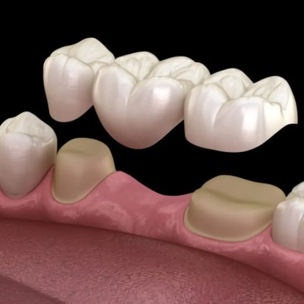 Accidental-damage-from-injury-or-biting-down-Quogue-NY