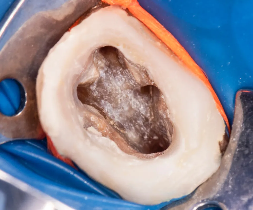 Cleaning-the-Root-Canal-Quogue-NY