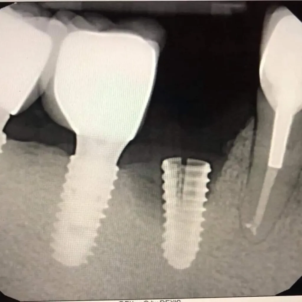 Cracked-or-fractured-implants-Quogue-NY