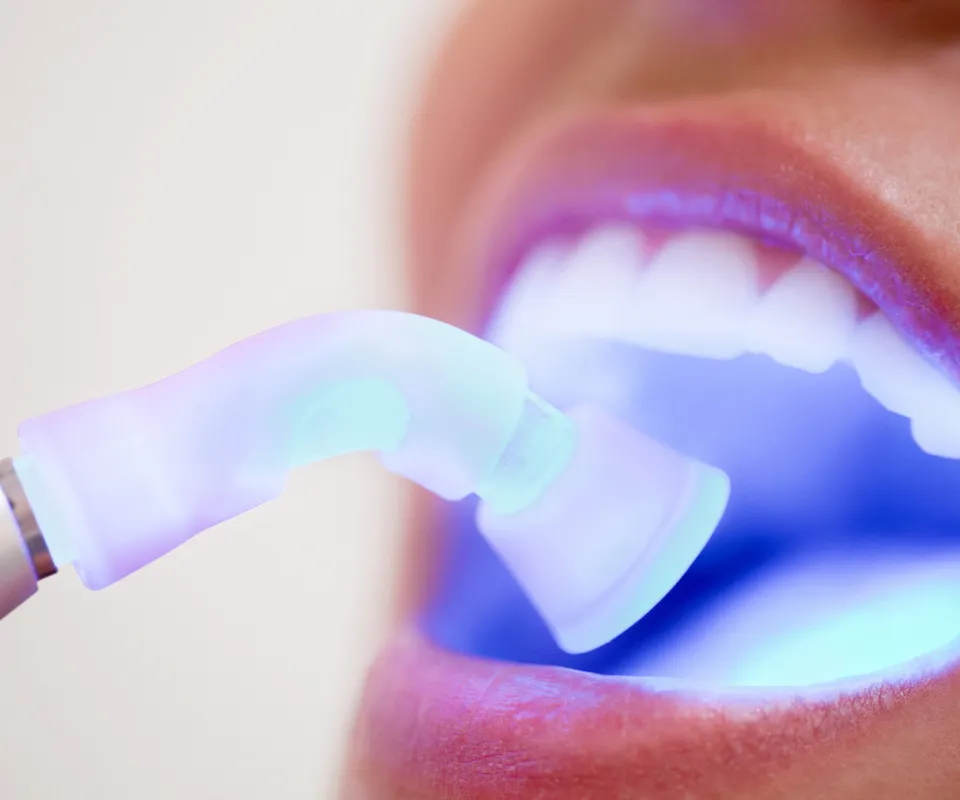 Dental-Bonding-or-Filling-Quogue-NY