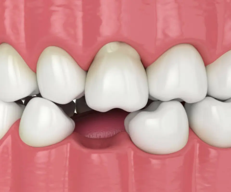 Dislocated-Teeth-Quogue-NY