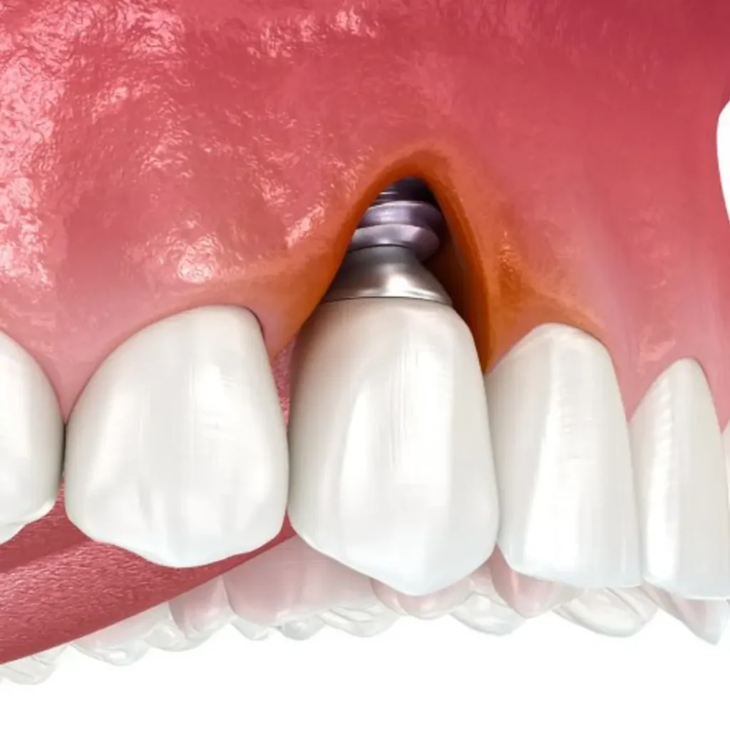 Infection-or-pain-around-an-implant-Quogue-NY