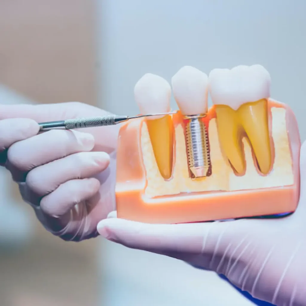 Loose-or-shifting-dental-implants-Quogue-NY