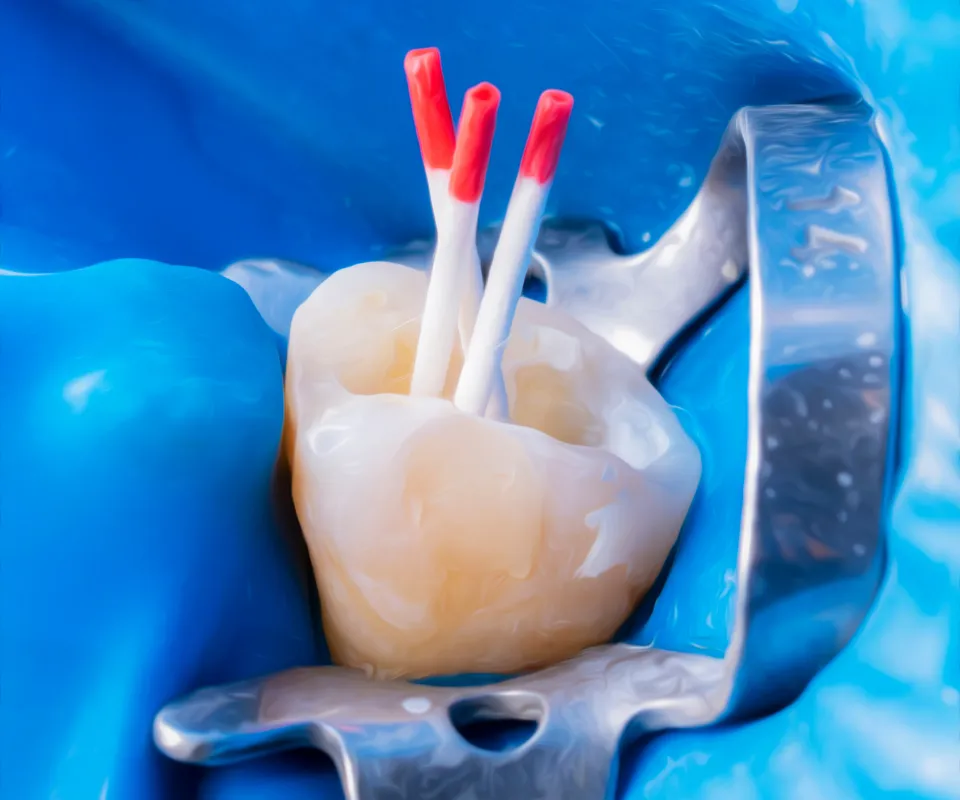 Root-Canal-Treatment-Process-Quogue-NY