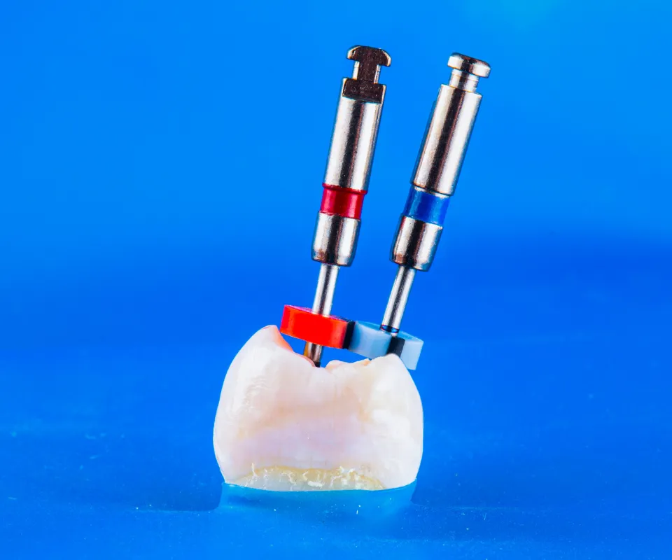 Root-Canal-Treatment-Quogue-NY