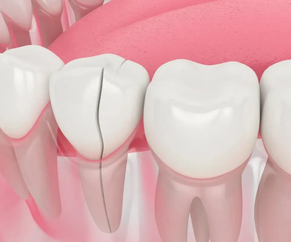 Split-Tooth-Quogue-NY