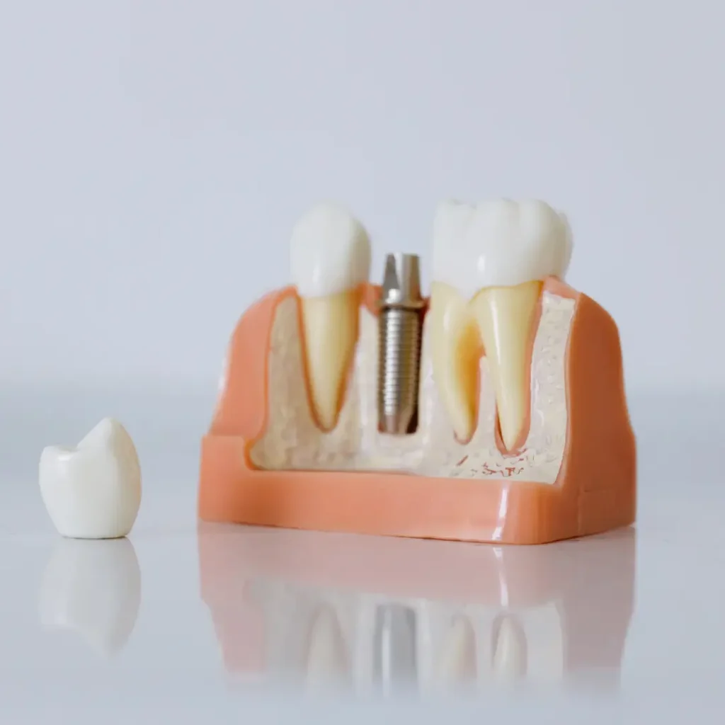 The-implant-crown-fell-off-or-broke-Quogue-NY