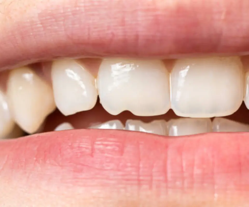 Tooth-Fractures-Quogue-NY