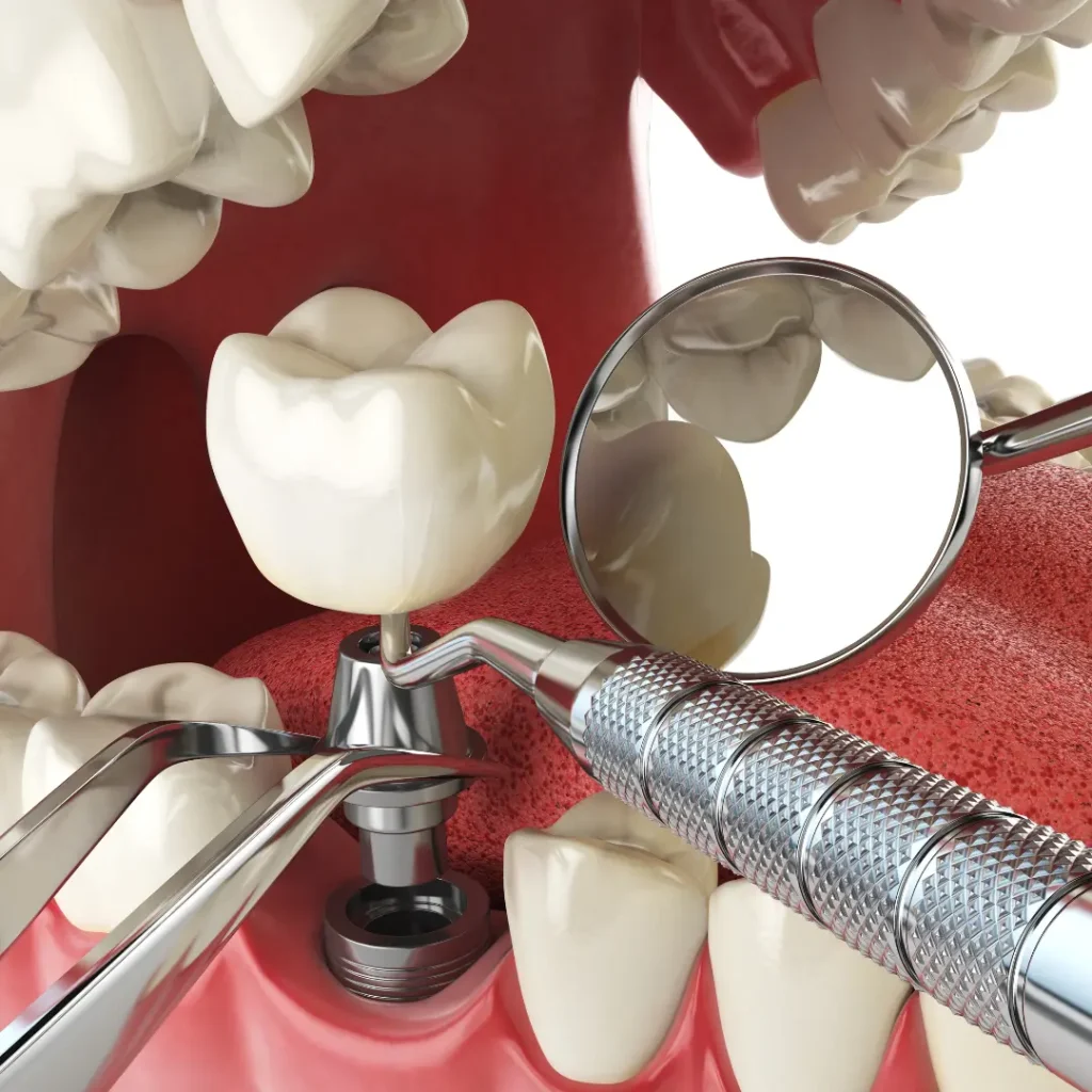 Trauma-related-tooth-loss-needs-immediate-implants-Quogue-NY