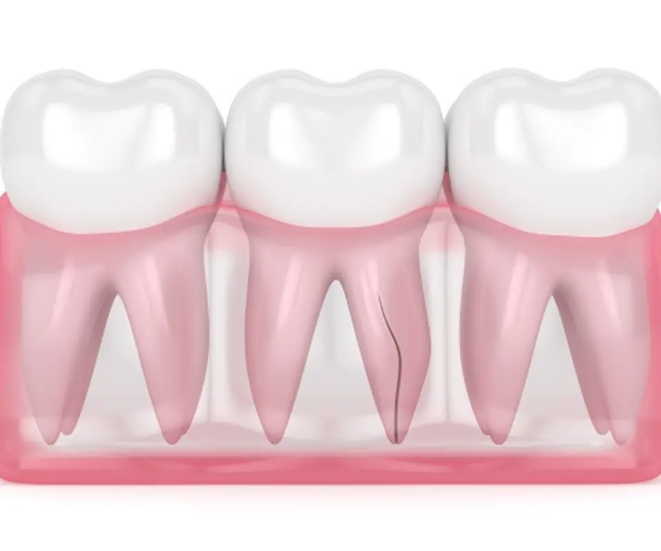 Vertical-Root-Fracture-Quogue-NY