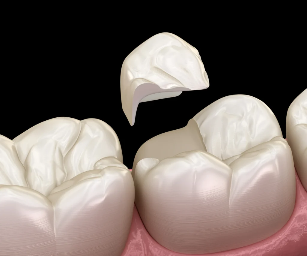 What-Causes-a-Cracked-Tooth-Quogue-NY