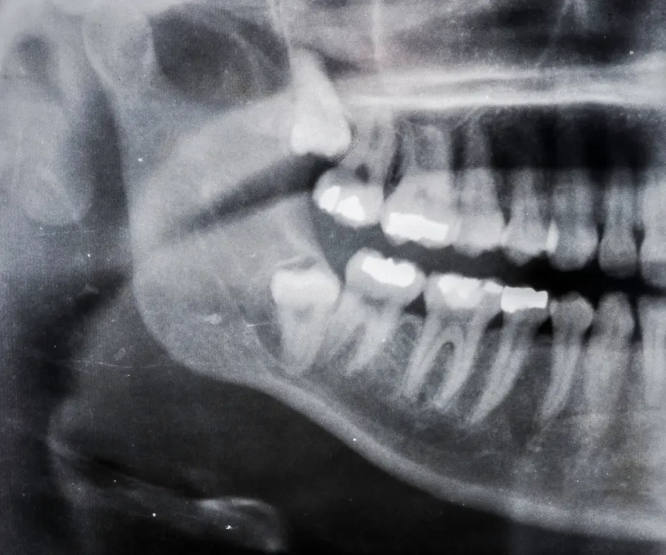 Wisdom-Tooth-Complications-Quogue-NY