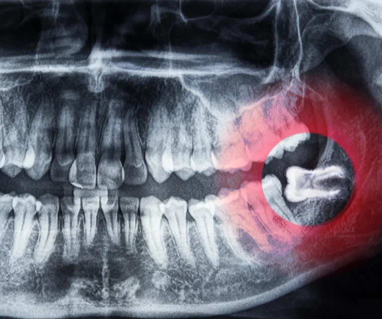 Wisdom-Tooth-Infection-Emergencies-Quogue-NY