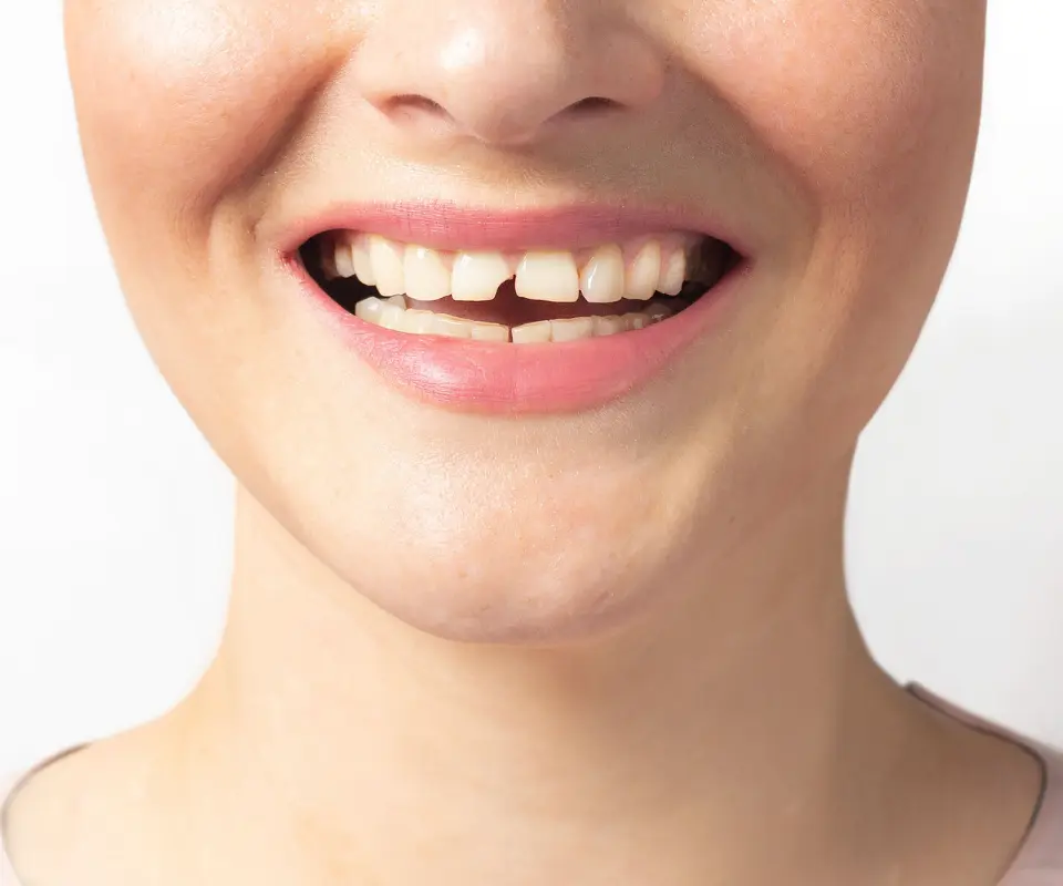 Cracked-or-Broken-Teeth-Quoge-NY